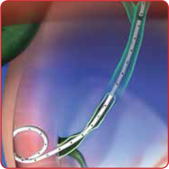 losen-biliary-locking-RBDC