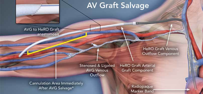 AV-Transplantat-Salvage——HeRO-Transplantat”width=