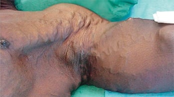 Arm swelling totally occluded