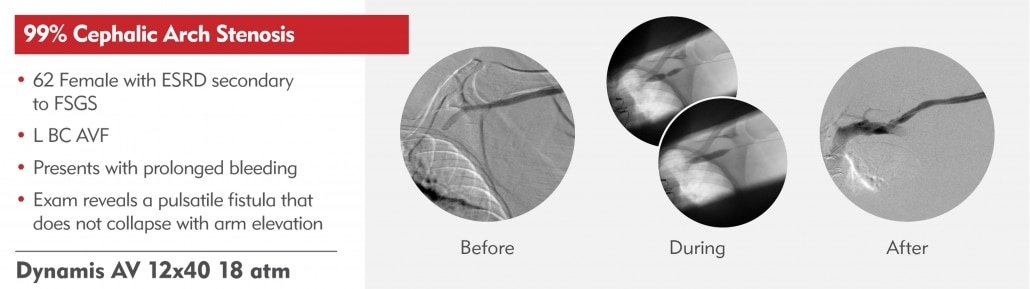 99% -cephalic-arch-stenosis-2 -