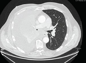 肺狭窄处理-病例研究4 -内镜检查