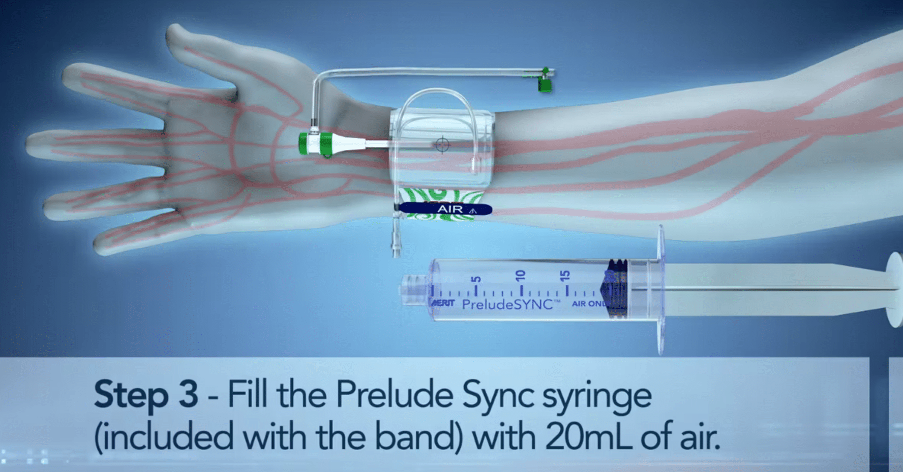 PreduleSync注射器与压缩带