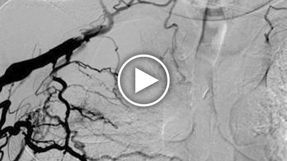 Videostill静脉zentralvenosen Pathologie,死麻省理工学院英雄贪污behandelt将