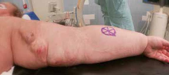 和平42 años con ERT con antecedente de múltiples重新干预