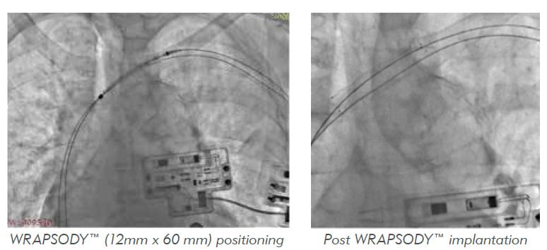 Colocación de WRAPSODY™(12毫米x 60毫米)e implantación后部de WRAPSODY
