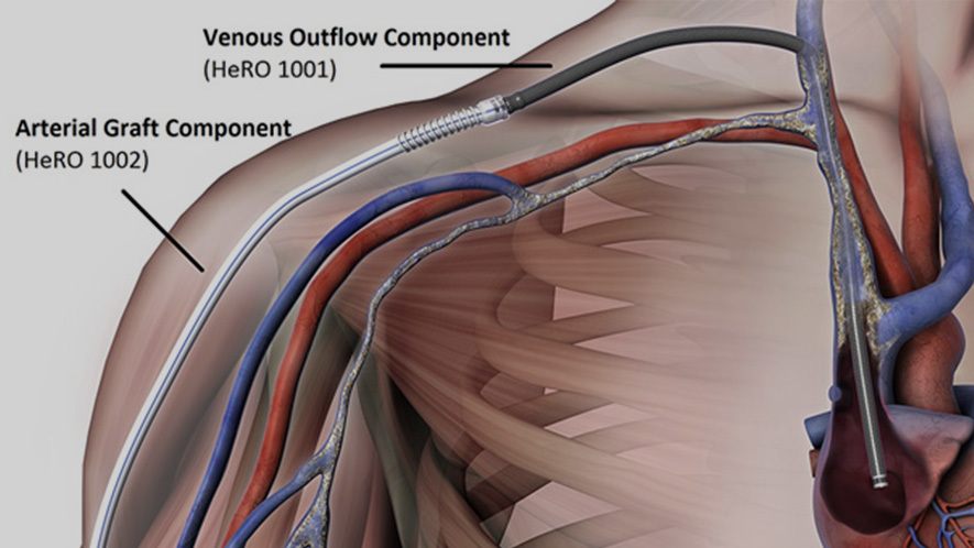 英雄贪污 - 血液透析可靠的流出