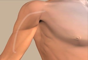 HeRO移植-血液透析可靠流出