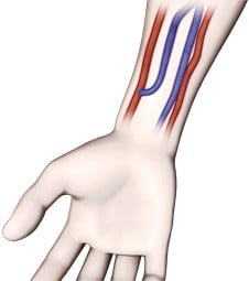 image-Dialysis-Access-1