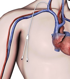 image-Dialysis-Access-3