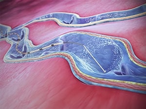 ClariVein IC输液导管