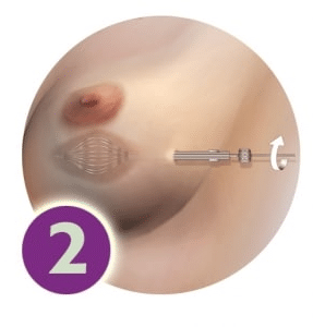 SAVI Brachy -步骤2 -扩展