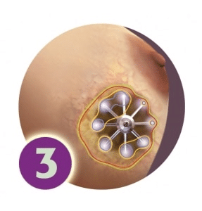 SAVI Brachy -步骤3 -辐射交付