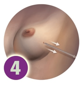 SAVI Brachy -步骤4 -删除