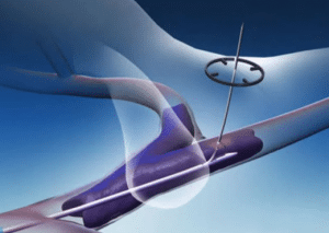 表面现在可在美国-功绩医疗