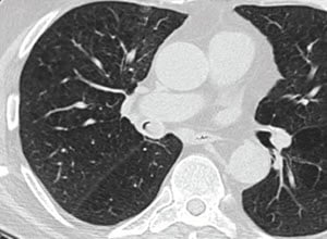 肺狭窄的处理-病例研究1 -需要内镜检查