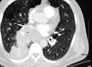 肺狭窄处理-病例研究2 -内镜检查