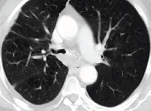 肺部狭窄的处理-案例研究3 -优点内窥镜检查