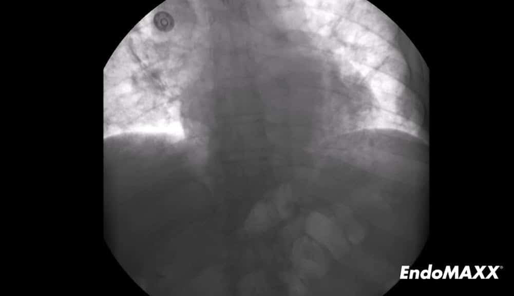 经近端缝合行EndoMAXX切除术