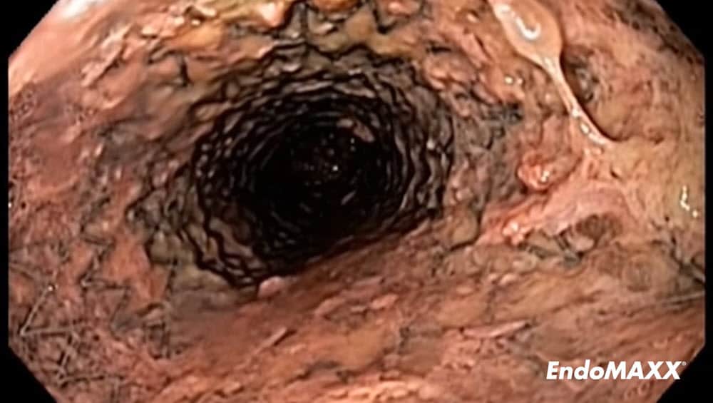 经近端缝合行EndoMAXX切除术