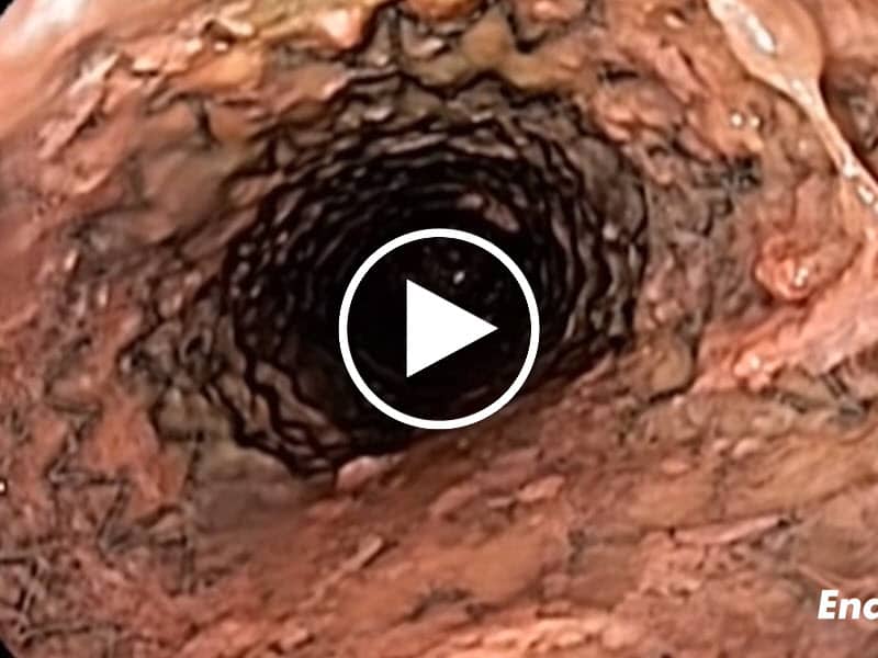 产品在服务视频- GI狭窄