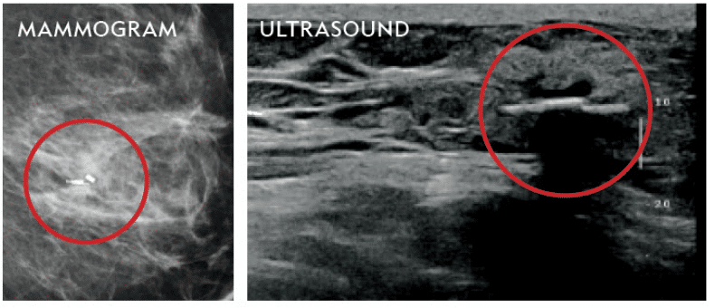 乳房X光检查和超声波的图像