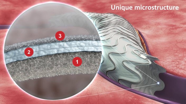 3 . elementi chiave dell' endoproteesi Merit WRAPSODY